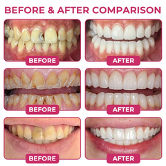 TERVENCE smile comparison